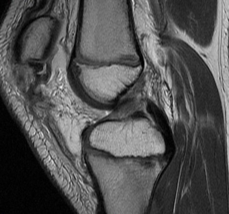 Figure 2 for case Patellar sleeve avulsion